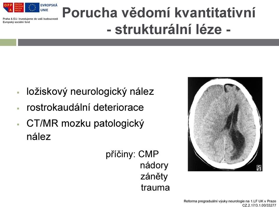 nález rostrokaudální deteriorace CT/MR