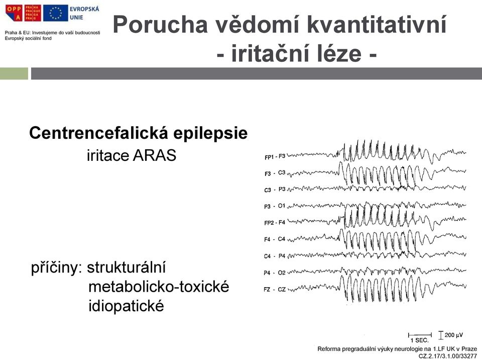epilepsie iritace ARAS příčiny: