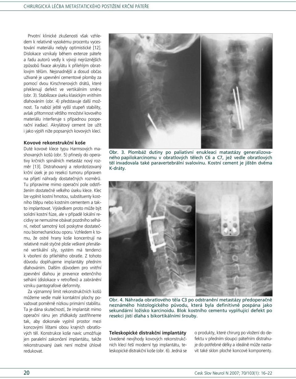 Chirurgická léčba metastatického postižení krční páteře - PDF Stažení zdarma