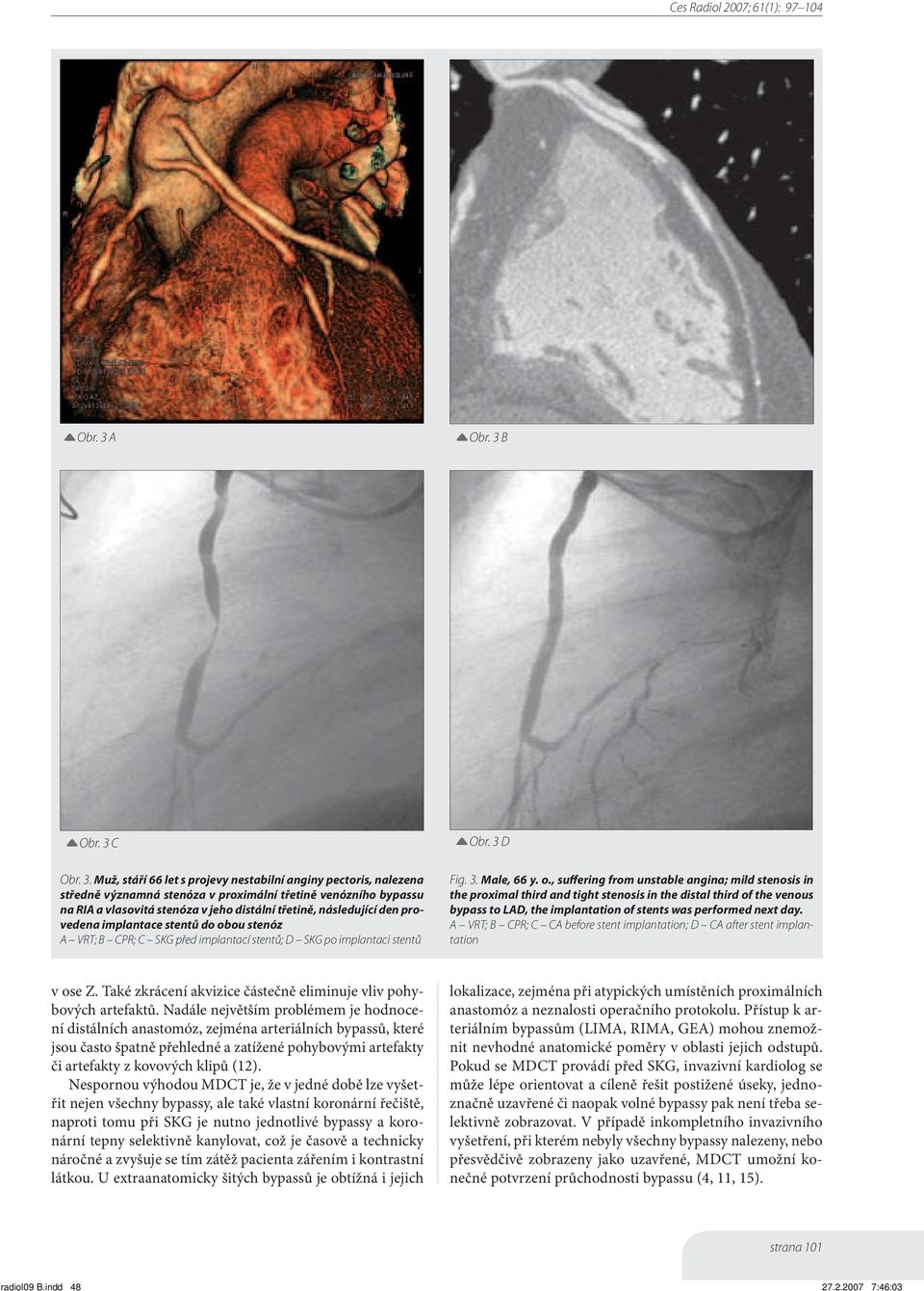 Muž, stáří 66 let s projevy nestabilní anginy pectoris, nalezena středně významná stenóza v proximální třetině venózního bypassu na RIA a vlasovitá stenóza v jeho distální třetině, následující den