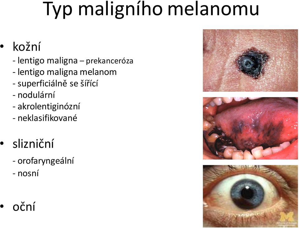 superficiálně se šířící - nodulární -