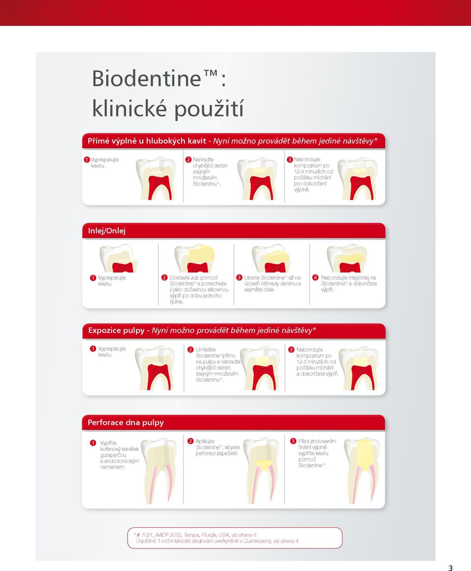 2 Dostavte zub pomocí Biodentine a ponechejte ji jako dočasnou sklovinou výplň po dobu jednoho týdne. 3 Uberte Biodentine až na úroveň náhrady dentinu a sejměte otisk.