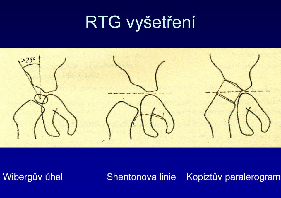 Shentonova linie