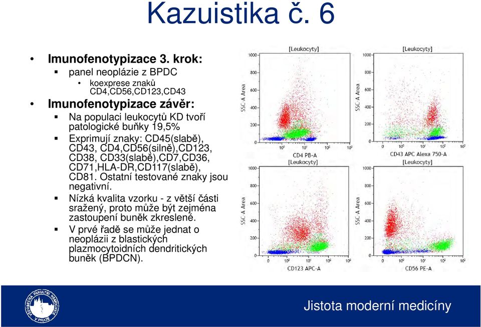 buňky 19,5% Exprimují znaky: CD45(slabě), CD43, CD4,CD56(silně),CD123, CD38, CD33(slabě),CD7,CD36, CD71,HLA-DR,CD117(slabě), CD81.