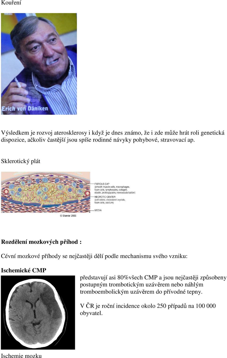 Sklerotický plát Rozdělení mozkových příhod : Cévní mozkové příhody se nejčastěji dělí podle mechanismu svého vzniku: Ischemické CMP