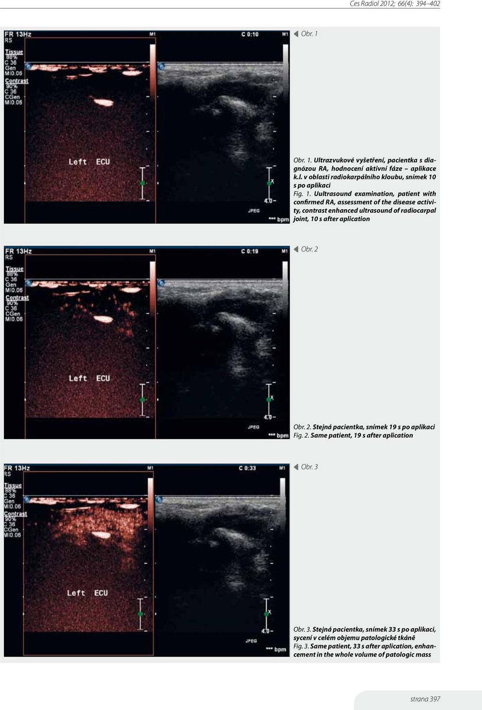 aplication Obr. 2 Obr. 2. Stejná pacientka, snímek 19 s po aplikaci Fig. 2. Same patient, 19 s after aplication Obr. 3 