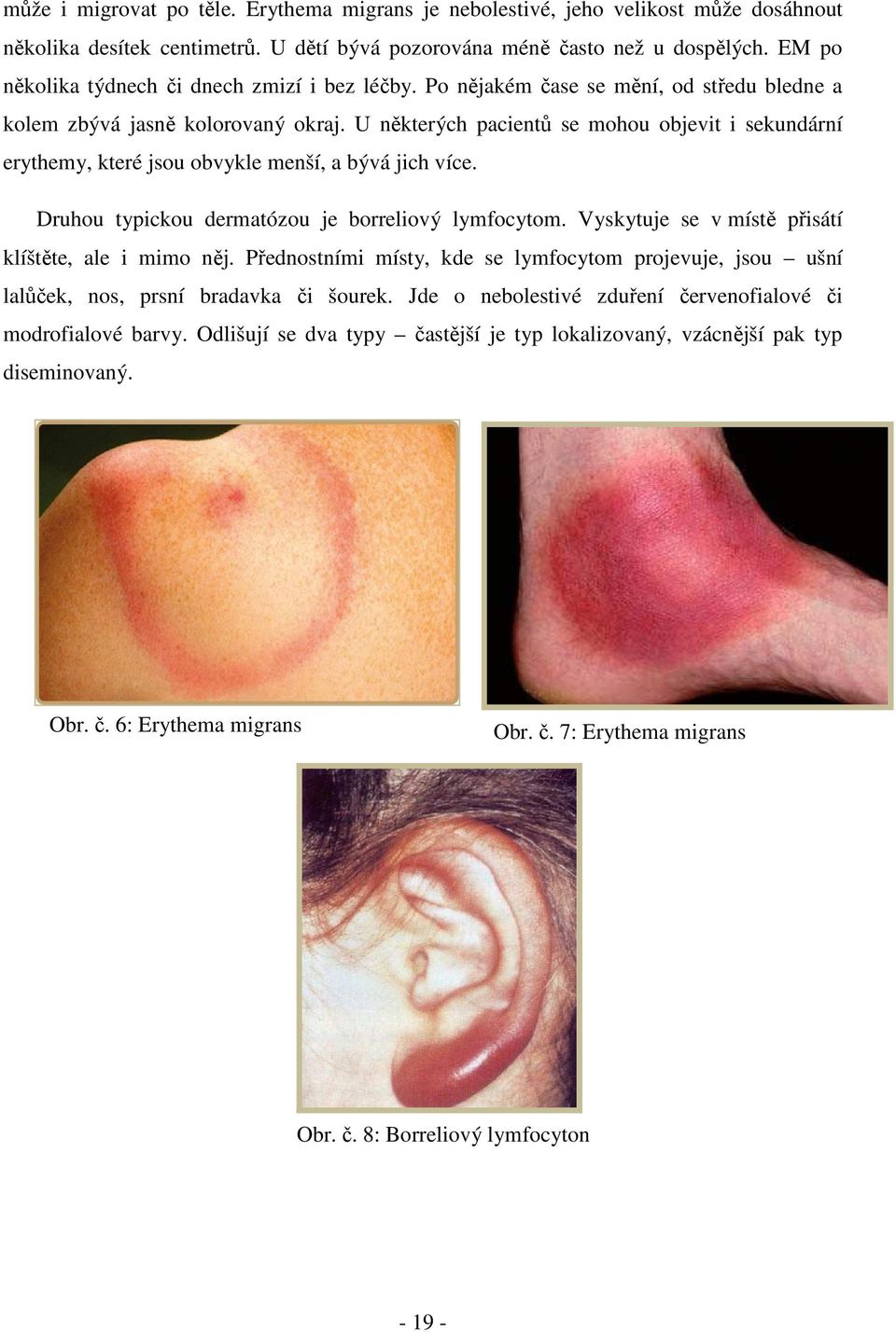 U některých pacientů se mohou objevit i sekundární erythemy, které jsou obvykle menší, a bývá jich více. Druhou typickou dermatózou je borreliový lymfocytom.