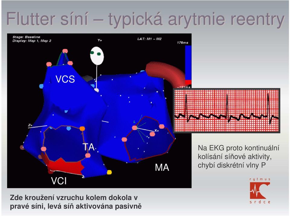 aktivity, chybí diskrétní vlny P Zde kroužení