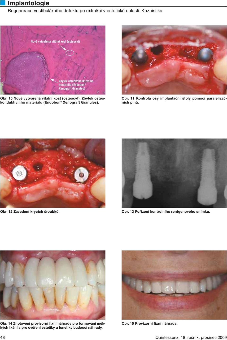 11 Kontrola osy implantační štoly pomocí paralelizačních pinů. Obr. 12 Zavedení krycích šroubků. Obr. 13 Pořízení kontrolního rentgenového snímku.
