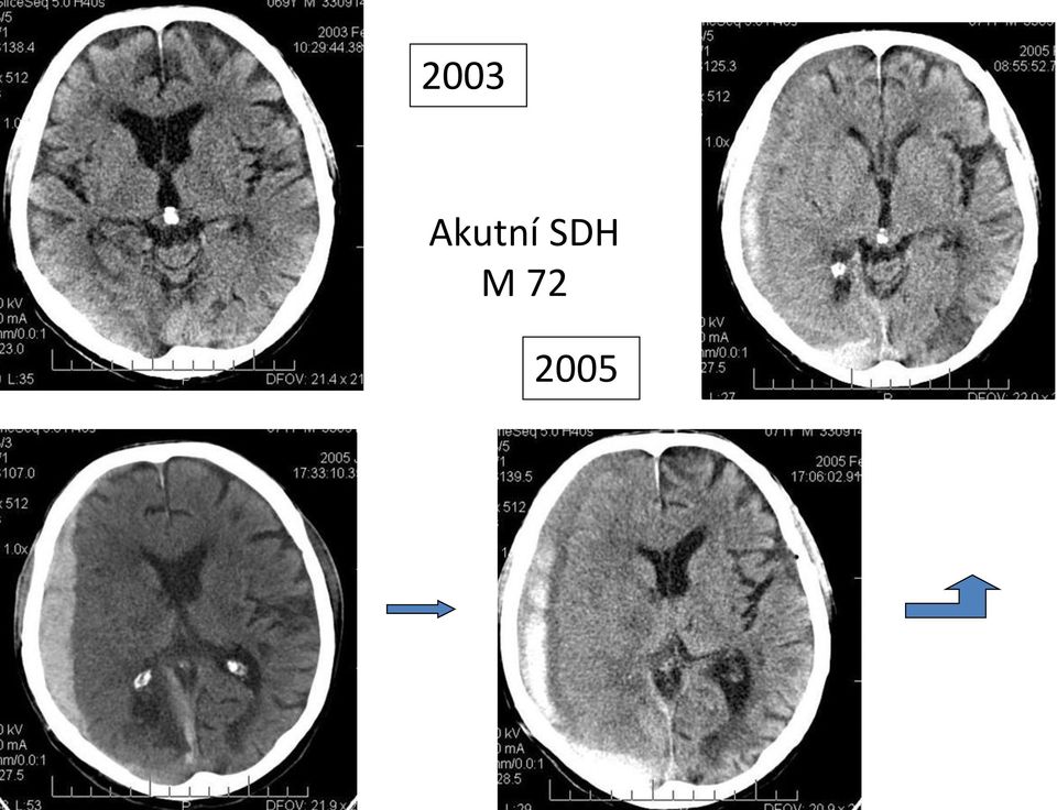 SDH M 72