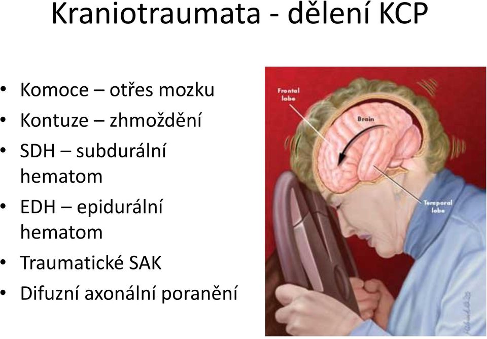 subdurální hematom EDH epidurální