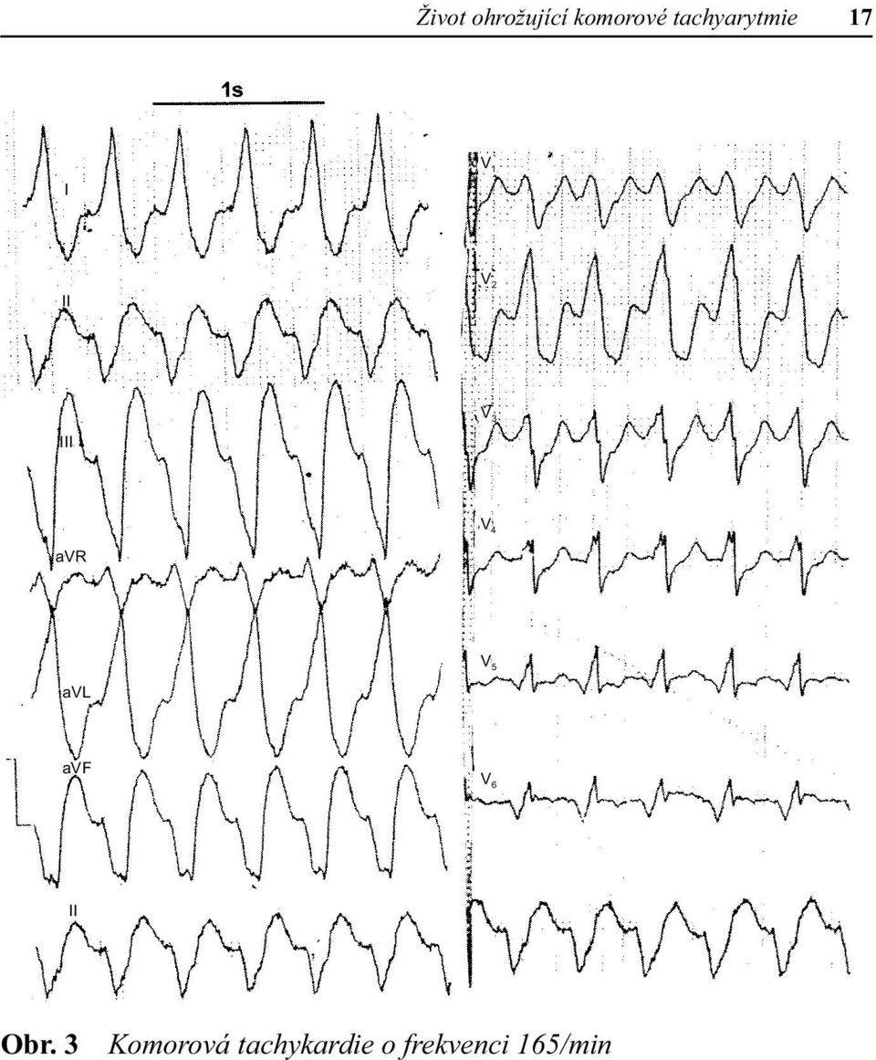 III V 4 avr V 5 avl avf V 6 II Obr.