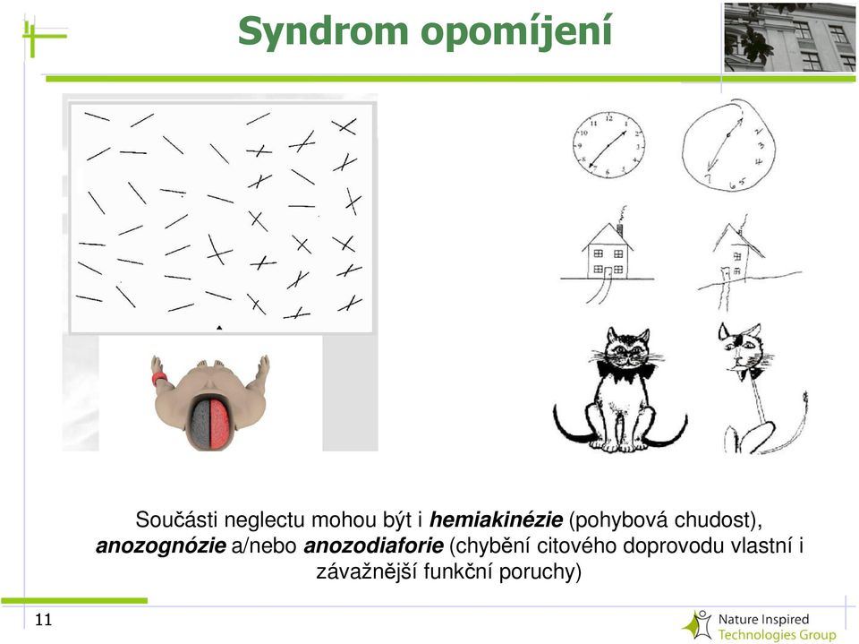 anozognózie a/nebo anozodiaforie (chybění