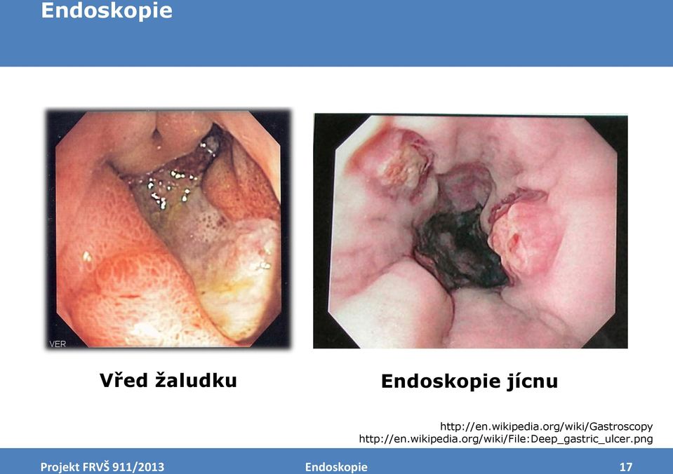 org/wiki/gastroscopy