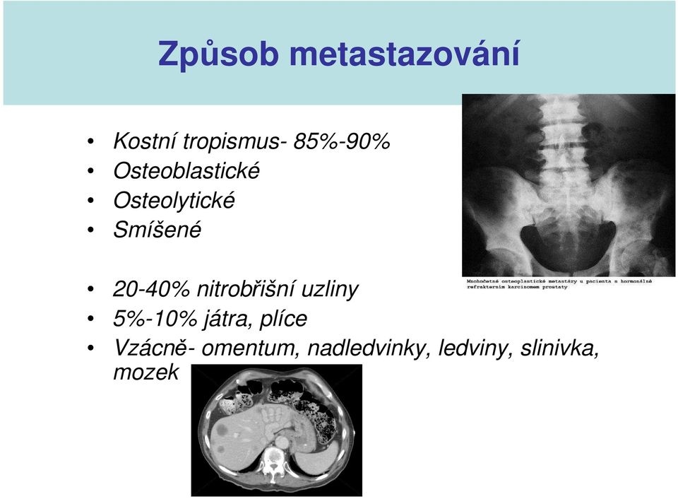 20-40% nitrobřišní uzliny 5%-10% játra, plíce