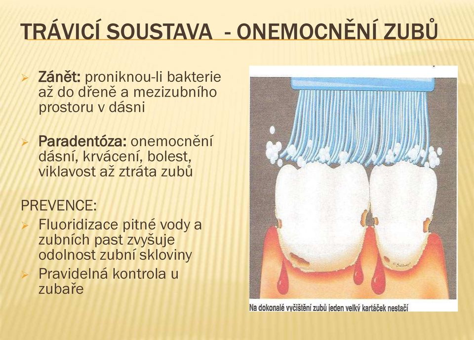 krvácení, bolest, viklavost až ztráta zubů PREVENCE: Fluoridizace pitné