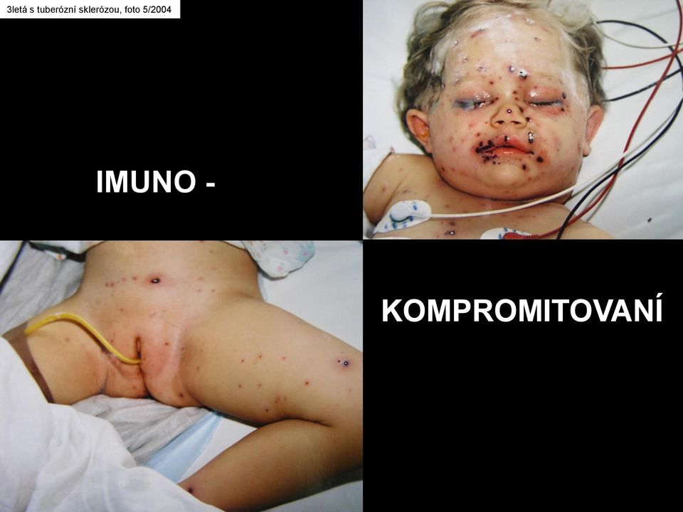 sklerózou, foto