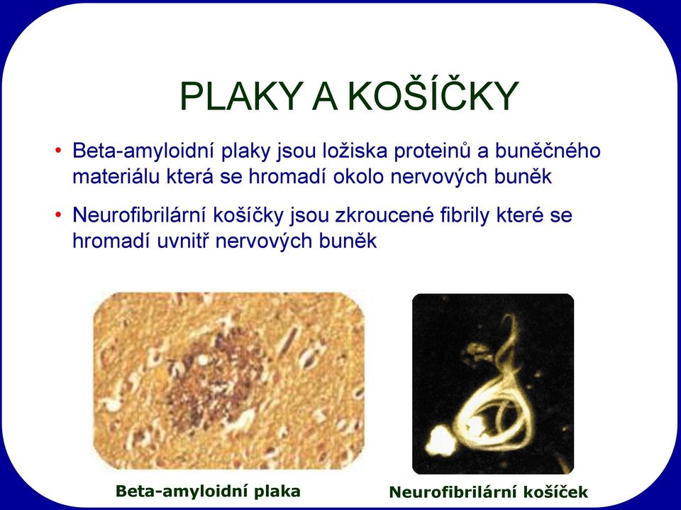 Neurofibrilární košíčky jsou zkroucené fibrily které se