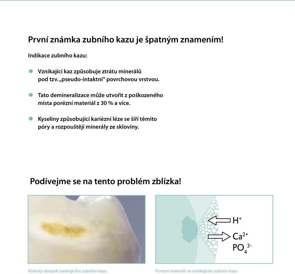Tato demineralizace může utvořit z poškozeného místa porézní materiál z 30 % a více.
