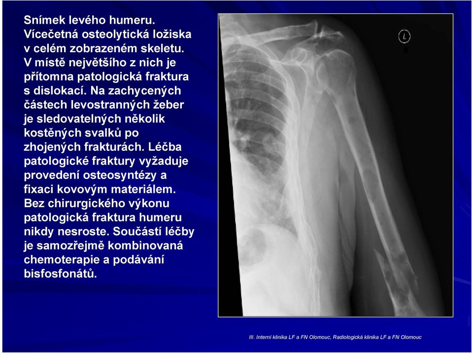 Na zachycených částech levostranných žeber je sledovatelných několik kostěných svalků po zhojených frakturách.