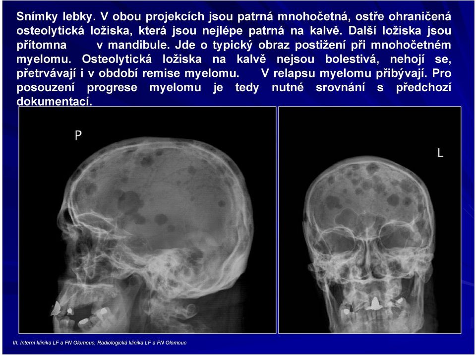 Další ložiska jsou přítomna v mandibule. Jde o typický obraz postižení při mnohočetném myelomu.