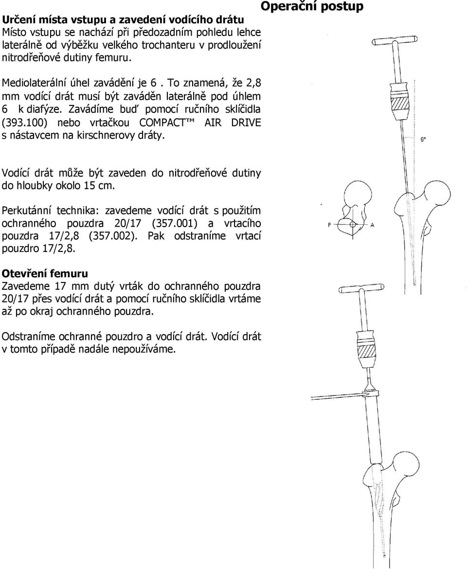 100) nebo vrtačkou COMPACT AIR DRIVE s nástavcem na kirschnerovy dráty. Vodící drát může být zaveden do nitrodřeňové dutiny do hloubky okolo 15 cm.