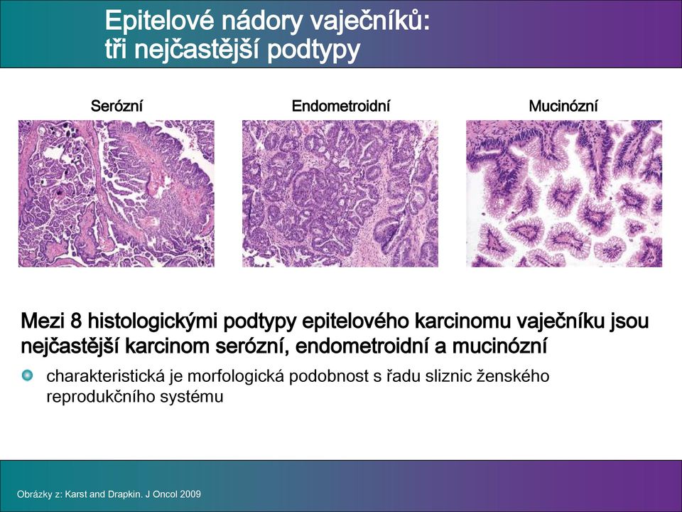 karcinom serózní, endometroidní a mucinózní charakteristická je morfologická