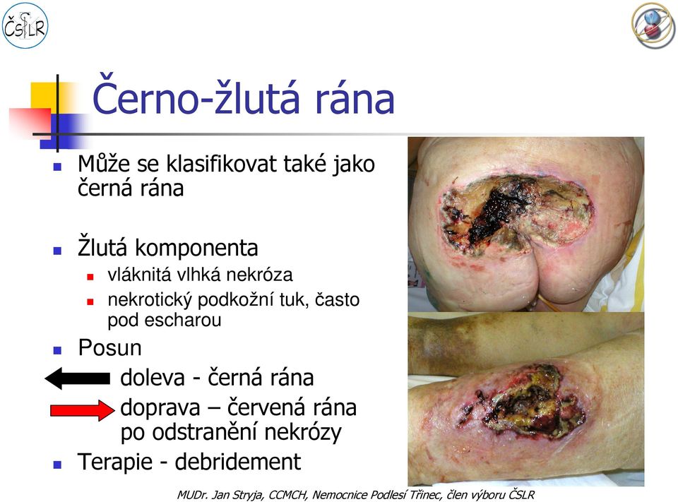 podkožní tuk, často pod escharou Posun doleva - černá rána