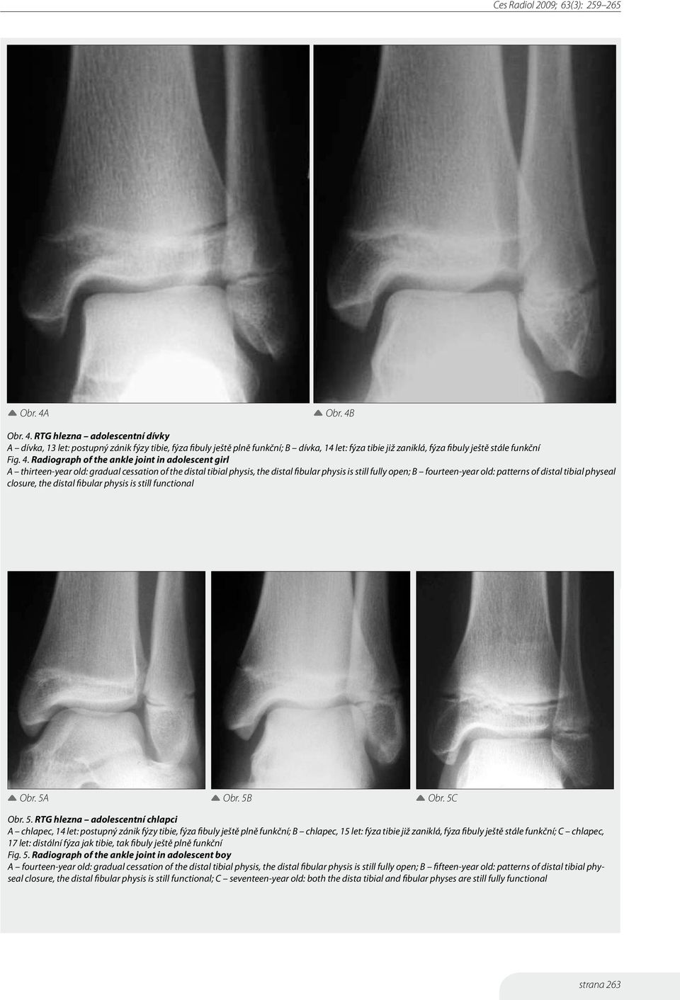 distal tibial physeal closure, the distal fibular physis is still functional Obr. 5A
