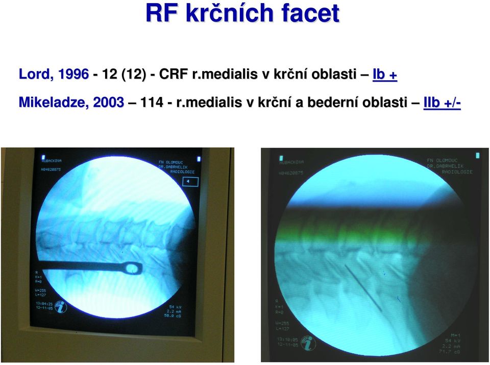 medialis v krční oblasti Ib +