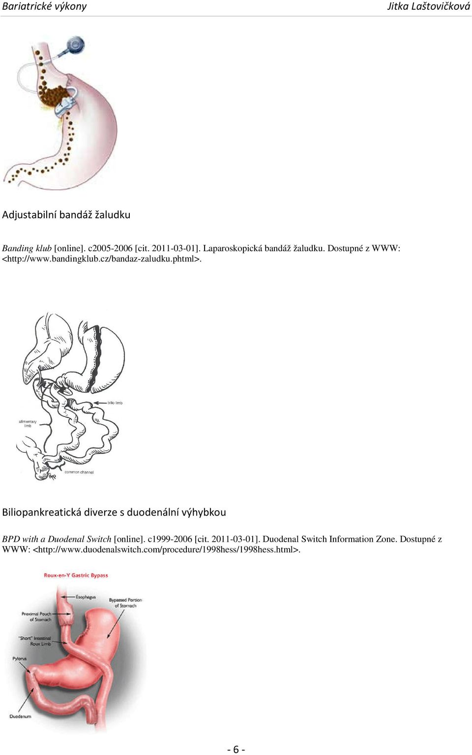 Biliopankreatická diverze s duodenální výhybkou BPD with a Duodenal Switch [online]. c1999-2006 [cit.