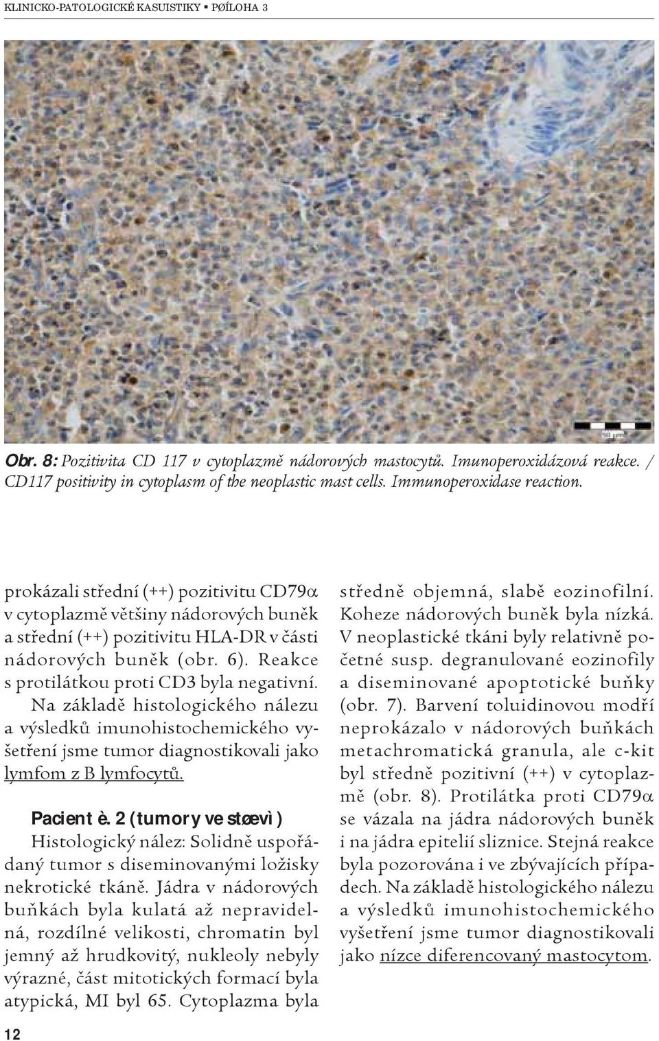 Na základì histologického nálezu a výsledkù imunohistochemického vyšetøení jsme tumor diagnostikovali jako lymfom z B lymfocytù. Pacient è.