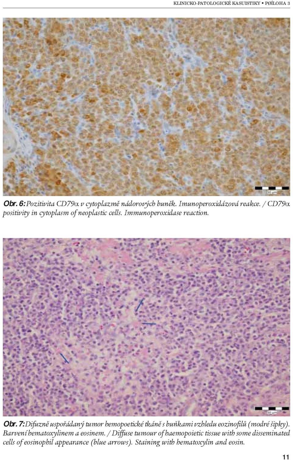 7: Difuznì uspoøádaný tumor hemopoetické tkánì s buòkami vzhledu eozinofilù (modré šipky).