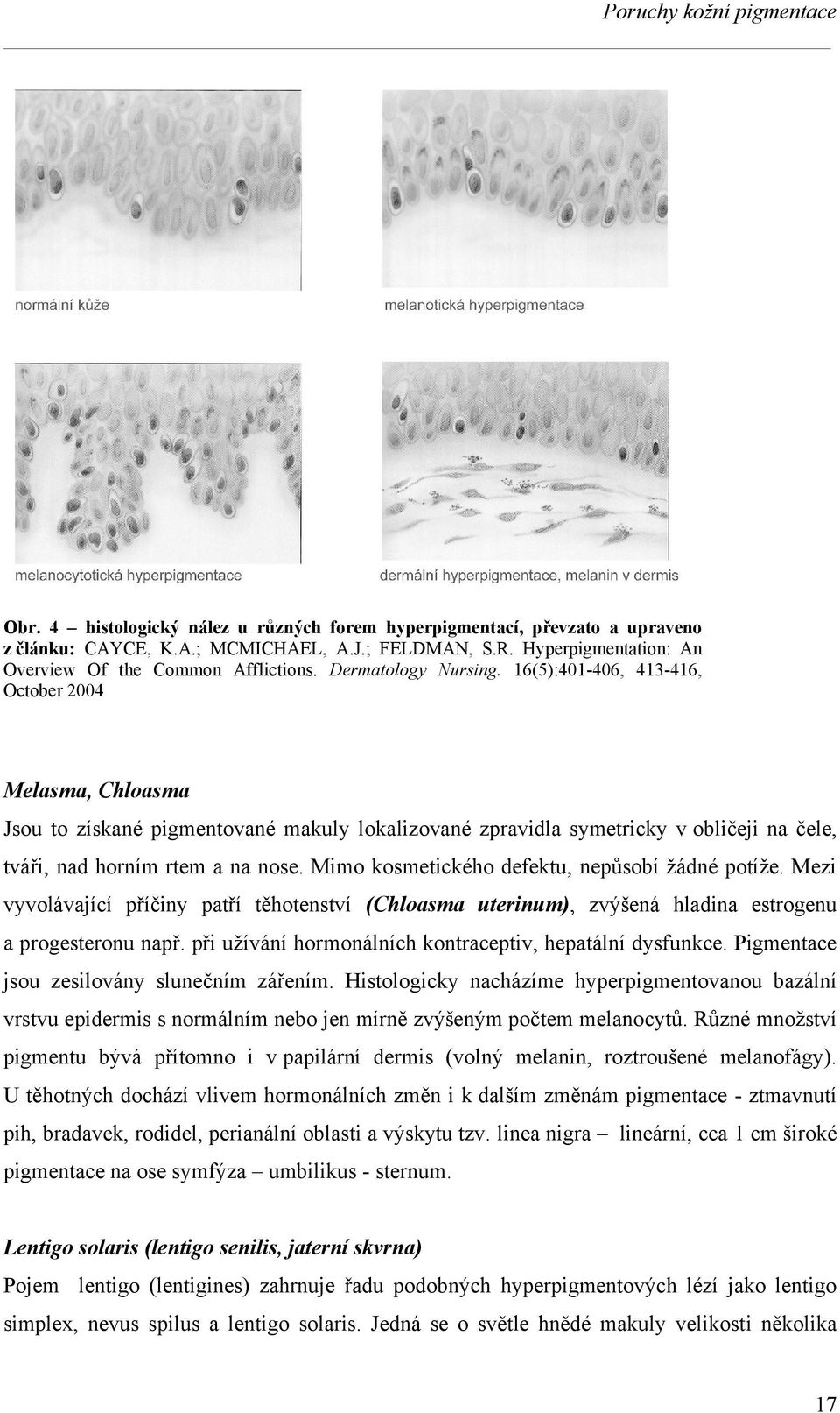 16(5):401-406, 413-416, October 2004 Melasma, Chloasma Jsou to získané pigmentované makuly lokalizované zpravidla symetricky v obličeji na čele, tváři, nad horním rtem a na nose.