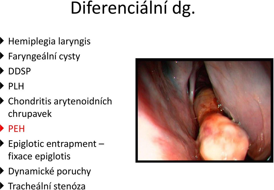 PLH Chondritis arytenoidních chrupavek PEH