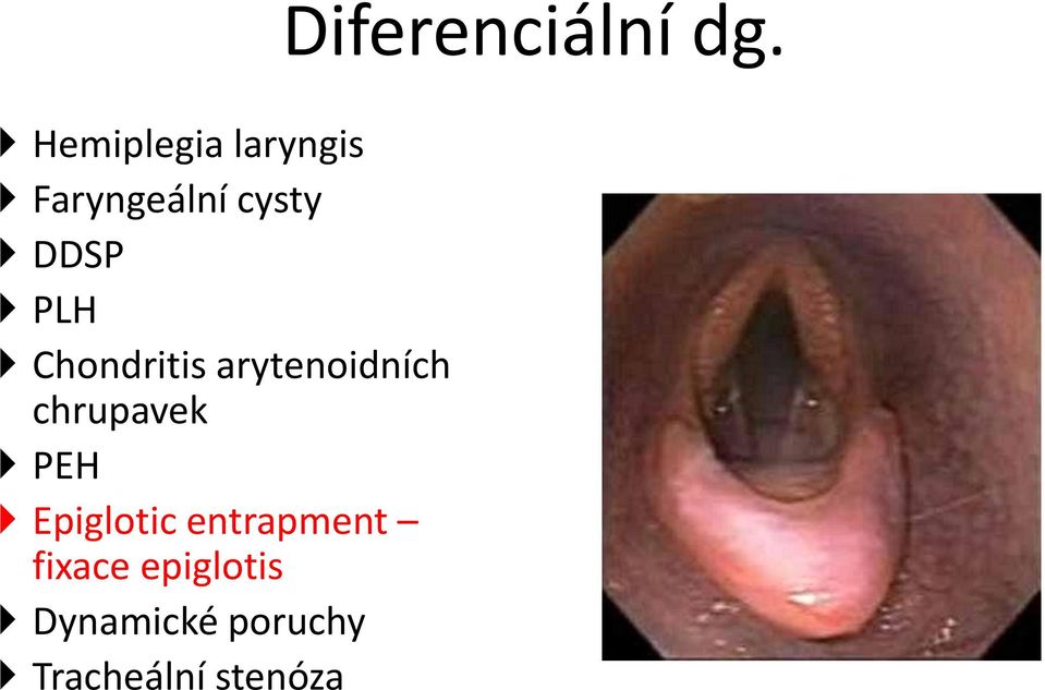 Epiglotic entrapment fixace epiglotis