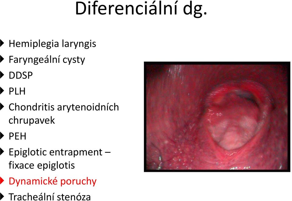 PLH Chondritis arytenoidních chrupavek PEH