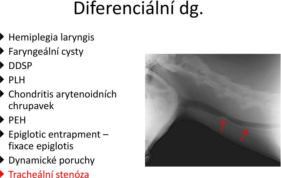 Epiglotic entrapment fixace epiglotis