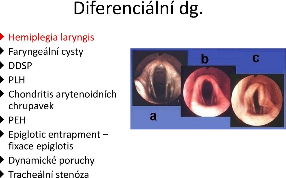 Epiglotic entrapment fixace epiglotis
