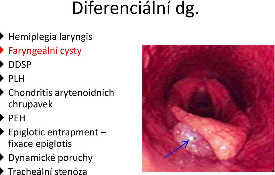 Epiglotic entrapment fixace epiglotis
