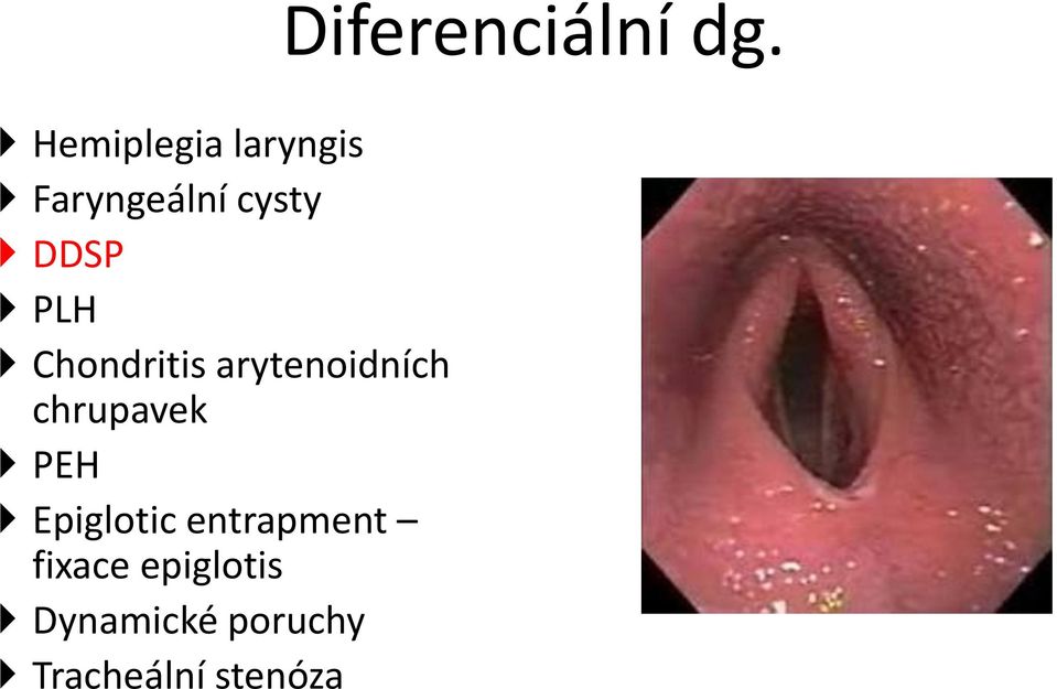 Epiglotic entrapment fixace epiglotis