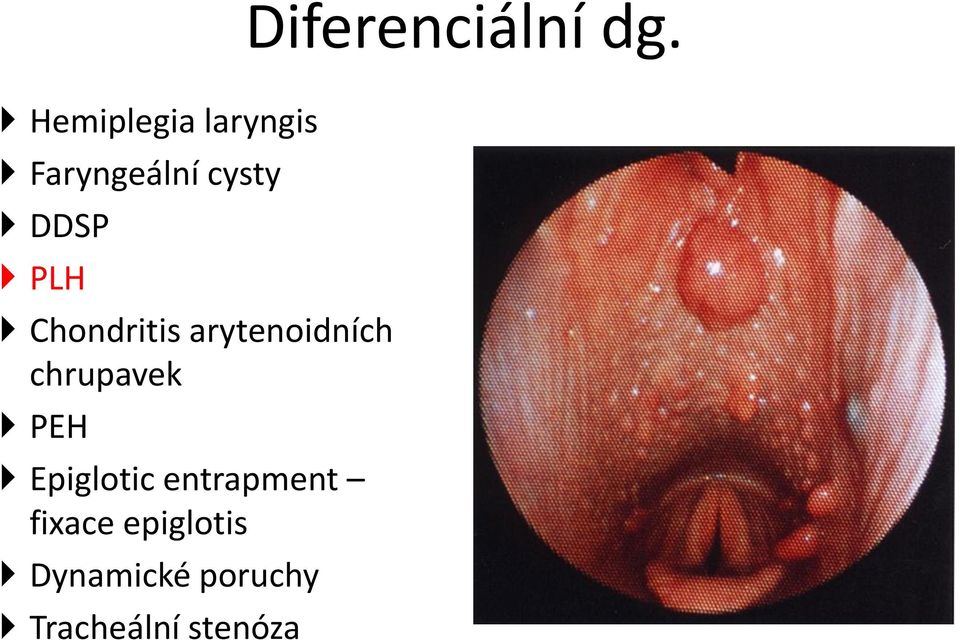 PLH Chondritis arytenoidních chrupavek PEH