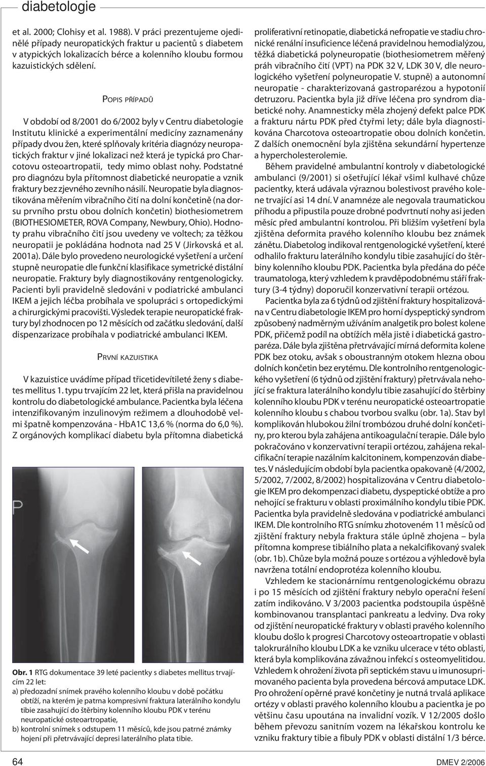 fraktur v jiné lokalizaci než která je typická pro Charcotovu osteoartropatii, tedy mimo oblast nohy.