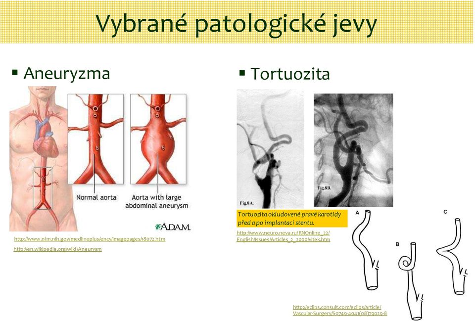 org/wiki/aneurysm Tortuozitaokludovenépravékarotidy před a po implantaci stentu. http://www.
