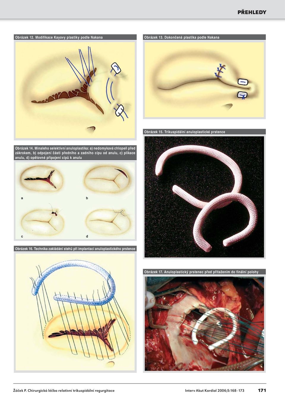 Minaleho selektivní anuloplastika: a) nedomykavá chlopeň před zákrokem, b) odpojení části předního a zadního cípu od anulu, c) plikace
