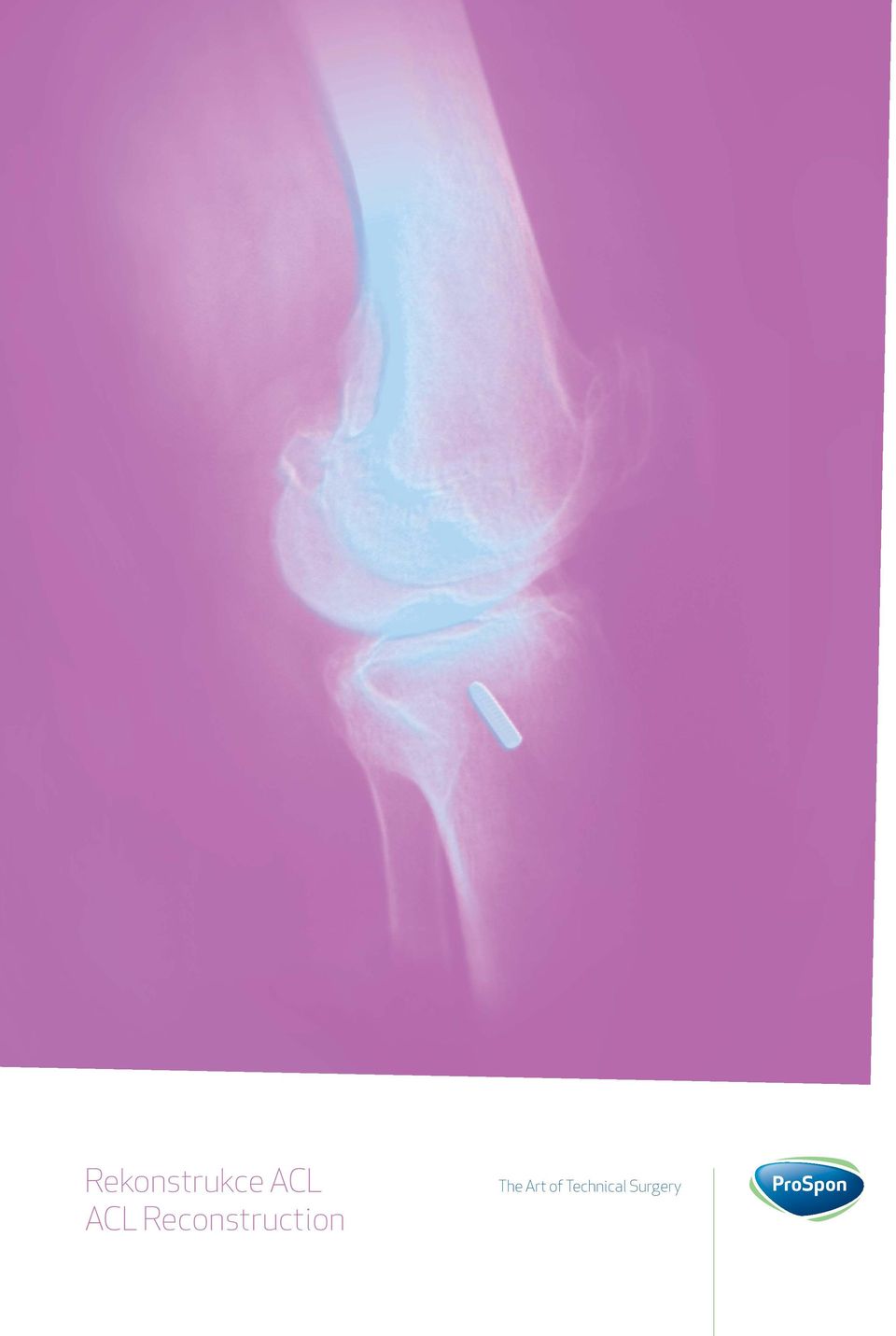 Reconstruction