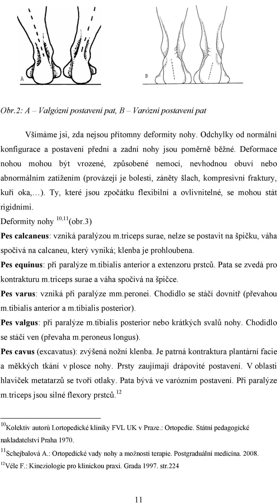 Ty, které jsou zpočátku flexibilní a ovlivnitelné, se mohou stát rigidními. Deformity nohy 10,11 (obr.3) Pes calcaneus: vzniká paralýzou m.