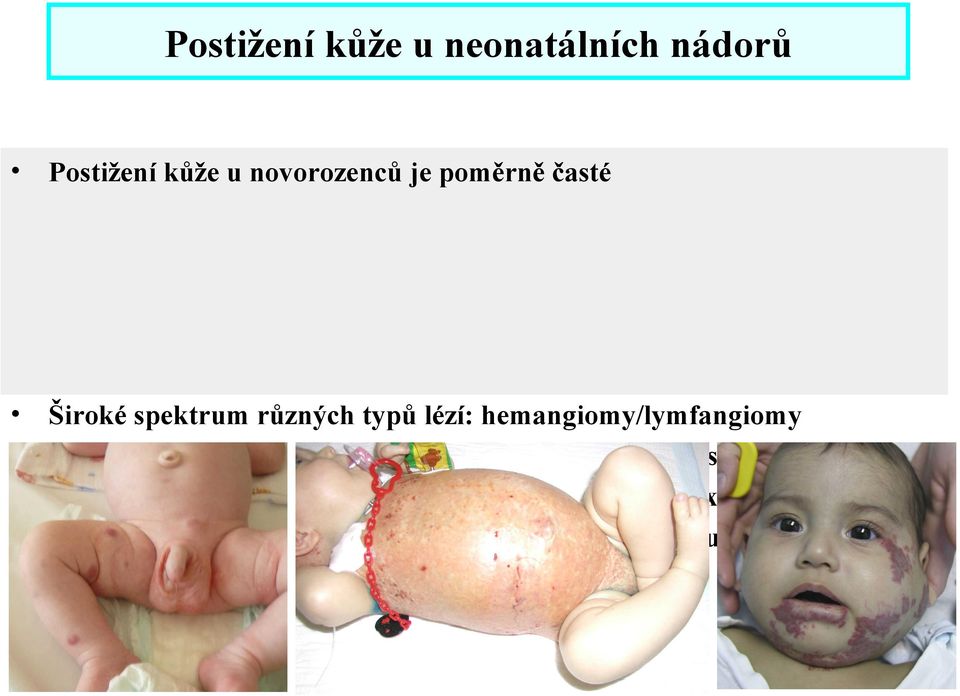 lézí: hemangiomy/lymfangiomy Langerhans cell histiocytosa