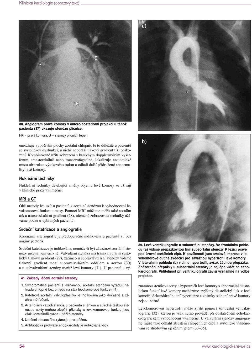 Kombinované užití zobrazení s barevným dopplerovským vyšetřením, transtorakálně nebo transezofageálně, lokalizuje anatomické místo obstrukce výtokového traktu a odhalí další přidružené abnormality