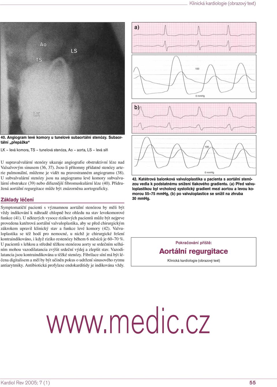 Jsou-li přítomny přídatné stenózy arterie pulmonální, můžeme je vidět na pravostranném angiogramu (38).